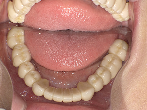 審美義歯症例